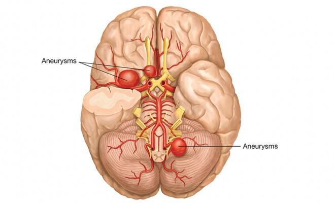 Aneurisma-Cerebrale-660x400.jpg