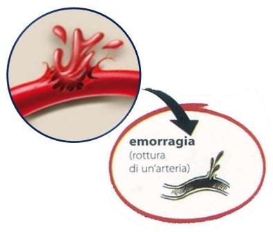 Ictus emorragico