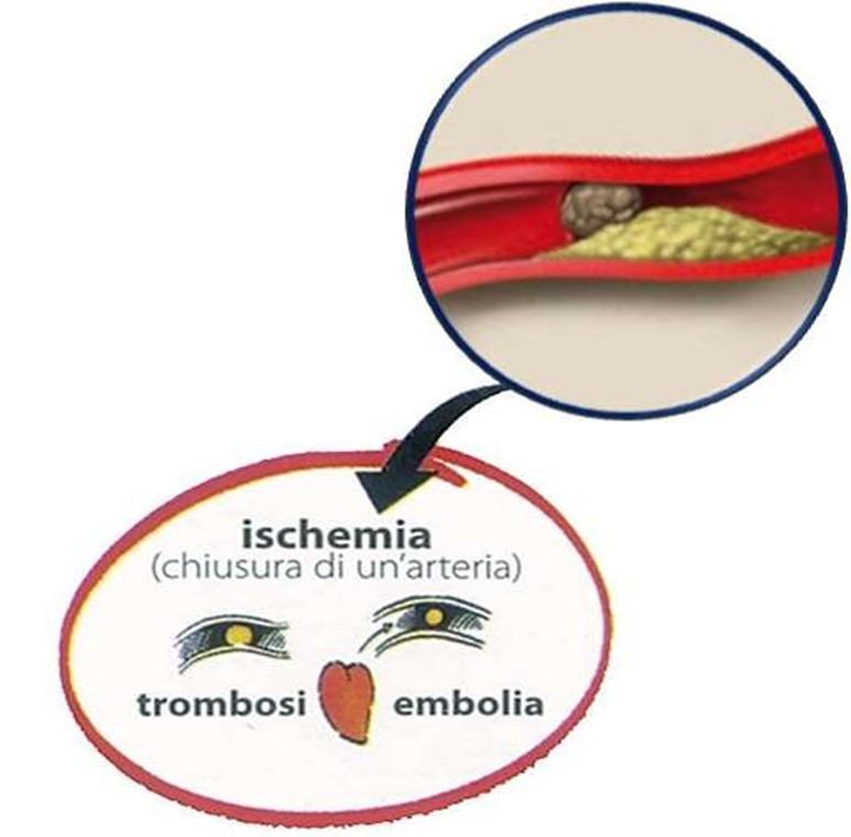 Ictus ischemico