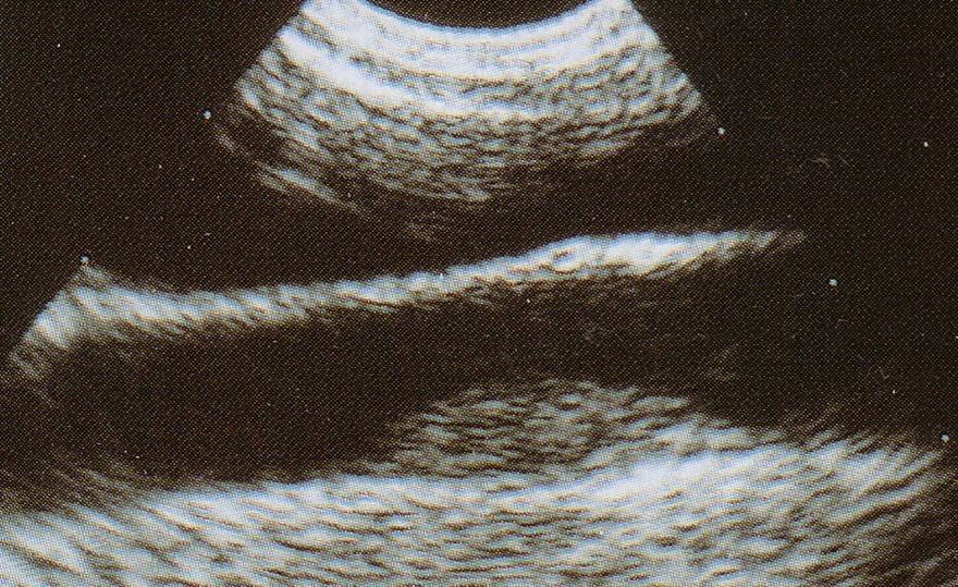 PLACCA ATEROSCLEROTICA DALLA CAROTIDE INTERNA