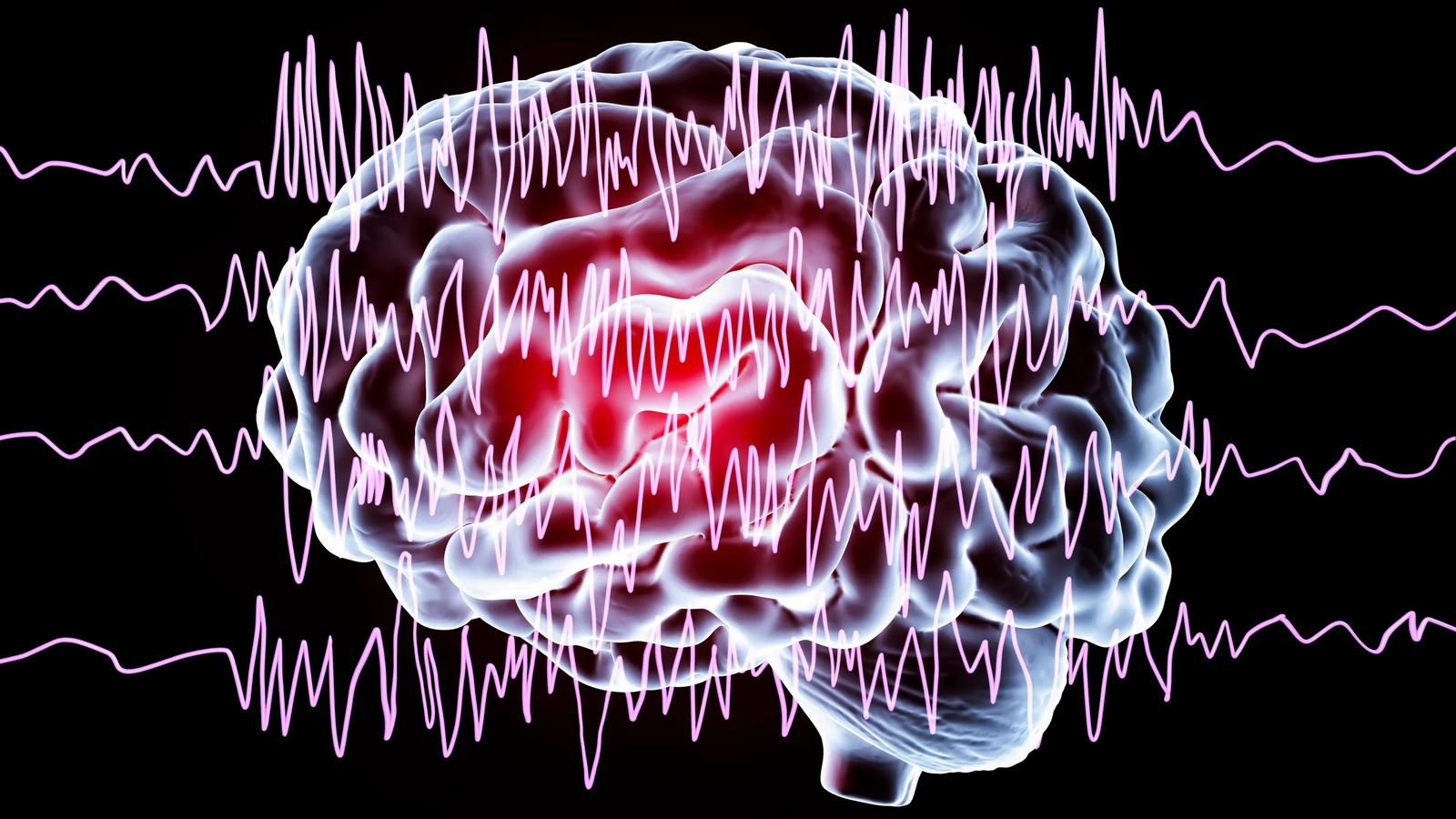 Epilessia post ictus: dopo i 60 anni, l’ictus cerebrale è la causa delle crisi nel 40% dei casi