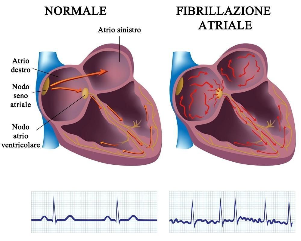 fibrillazione-atriale.jpg