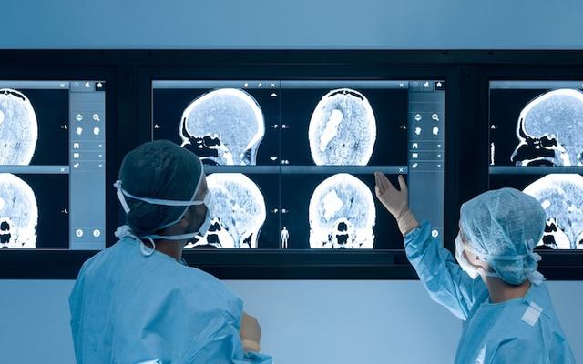 Ictus: l’arteria è riaperta ma il sangue non scorre, l’errore del cervello dopo l’ischemia