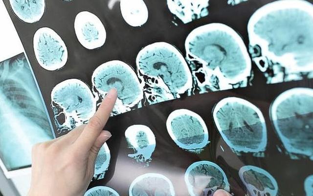 Repubblica Ictus lacunare, così danneggia il cervello, come nasce e come prevenirlo - immagine 1
