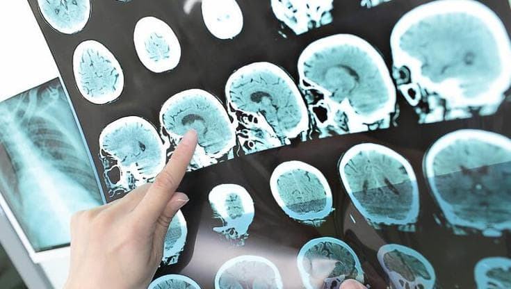 Repubblica Ictus lacunare, così danneggia il cervello, come nasce e come prevenirlo - immagine 1
